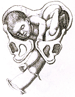 Illustration ur Marie Boivins bok, ett foster i livmodern och hur en arm från barnmorskan sträcks in